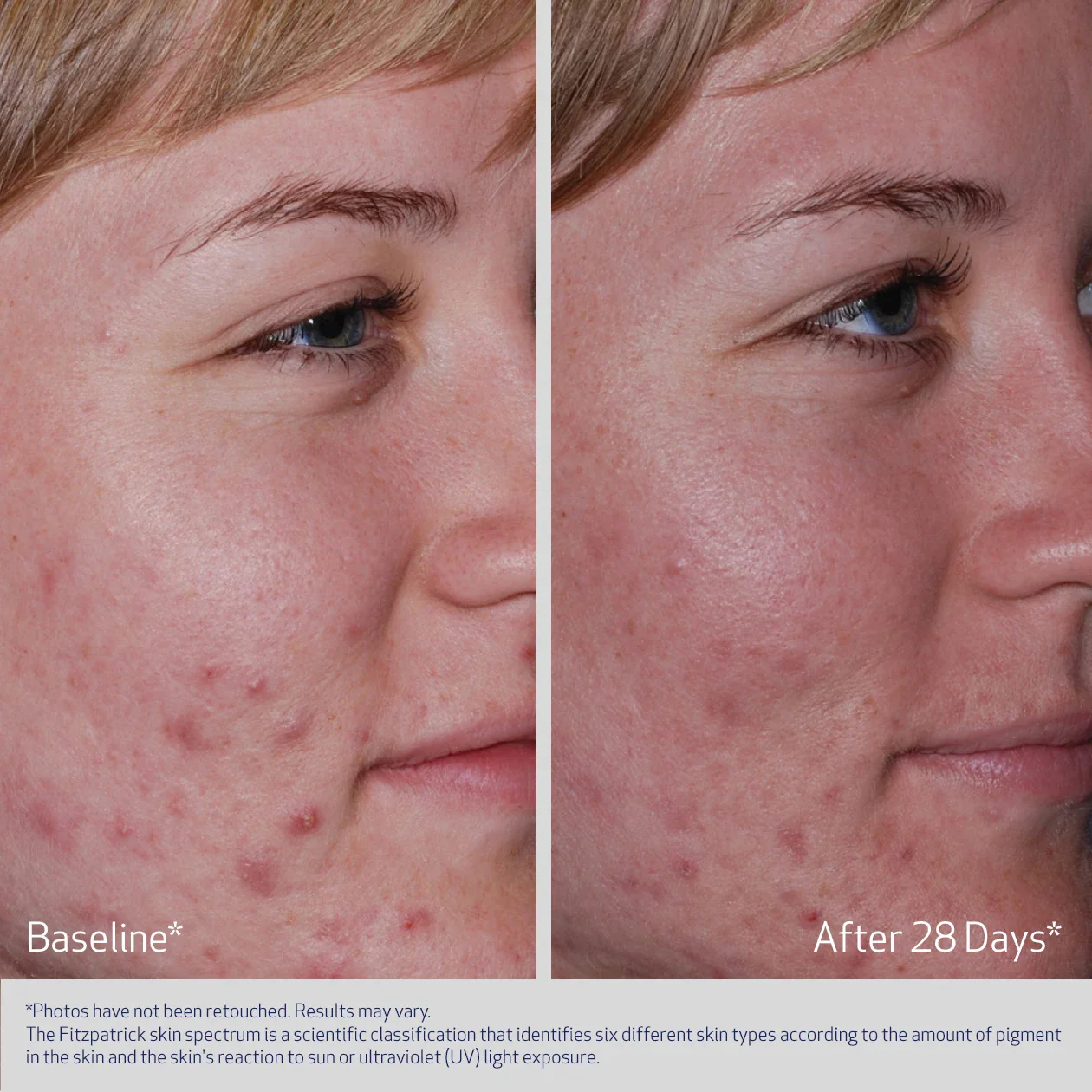 ACNE THERAPEUTIC SYSTEM - Image 5