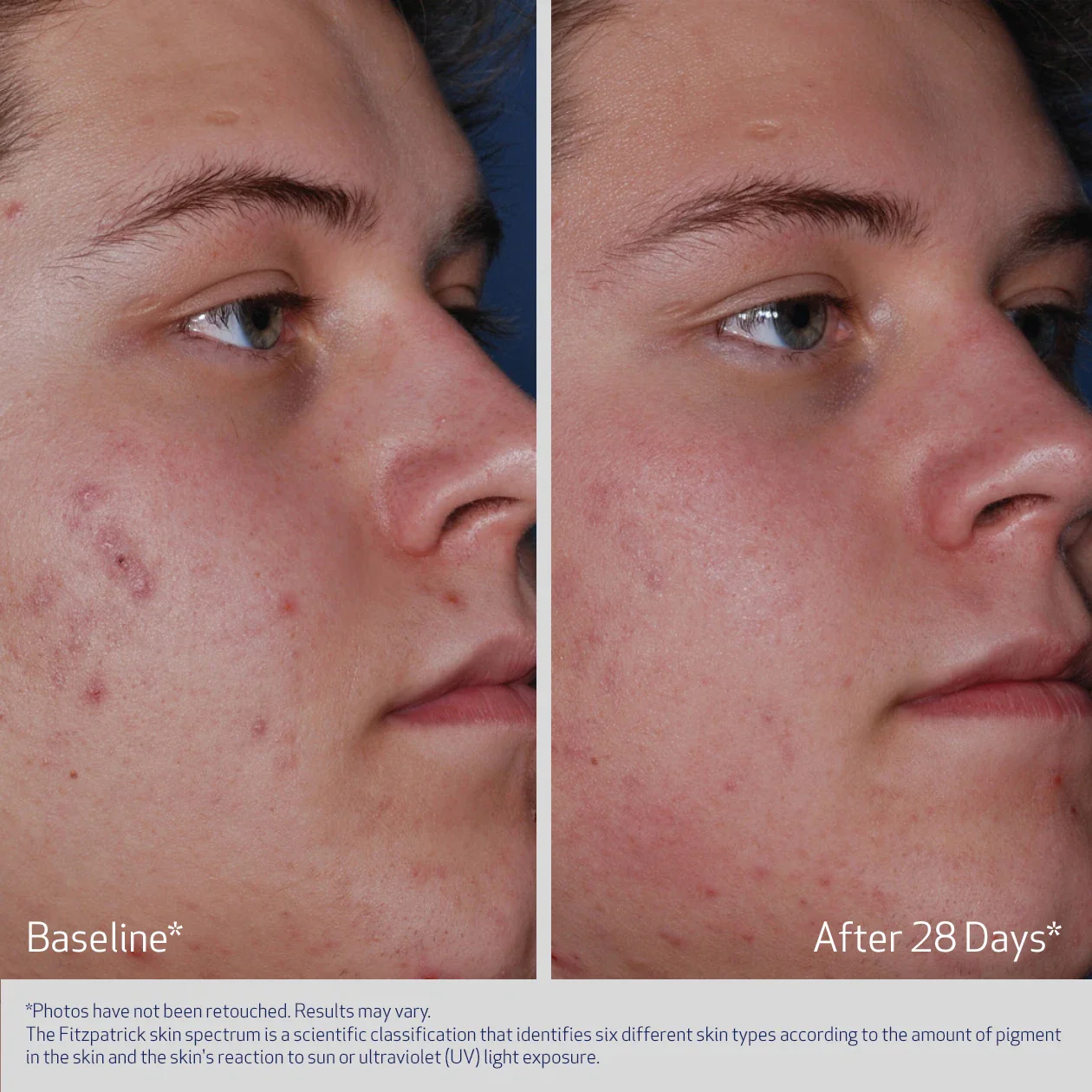 ACNE THERAPEUTIC SYSTEM - Image 6